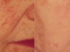 telangiectasia thread veins Castleknock cosmetic clinic Dublin 15