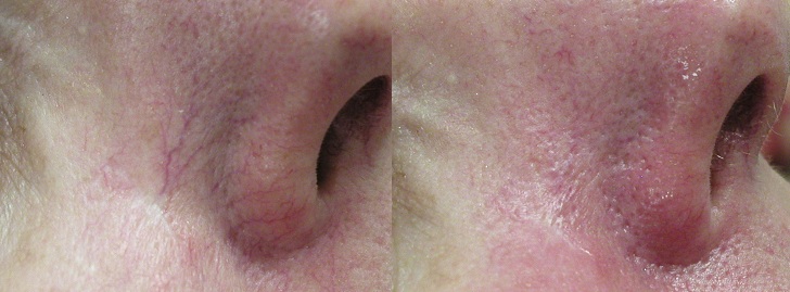 Veins on the nose Vascular Lesions thread veins laser cosmetic clinic Dublin