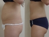 VASER Lipo to the Abdomen liposuction clinic dublin
