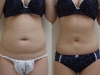 VASER Lipo to the tummy liposuction clinic dublin