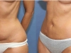 VASER Lipo to sagging tummy liposuction dublin