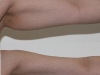 VASER Lipo arms liposuction clinic dublin