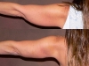 VASER Lipo to Arms liposuction clinic dublin