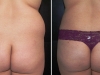 VASER Lipo to Love Handles Liposuction clinic dublin