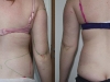 VASER Lipo Love Handles and Arms Liposuction clinic dublin