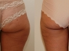 Vaser Saddle Bags - Liposuction clinic dublin 15