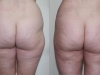 Vaser for saddle Bags - Liposuction clinic dublin 15