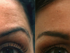 botox worry lines clinic dublin 15