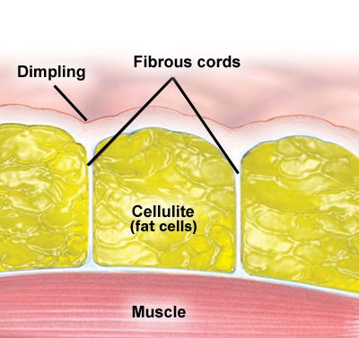 orange peel and cottage cheese cellulite anatomy