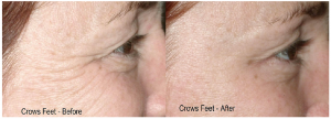 Injection with botox for crows feet anti wrinkle botulinum toxin