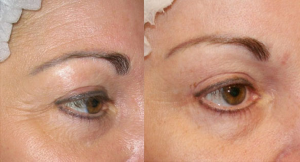Injection with botox for crows feet anti wrinkle botulinum toxin