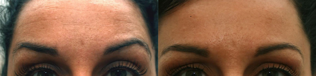 Smooth forehead with botox anti wrinkle injections muscle relaxant by qualified doctor cosmetic clinic