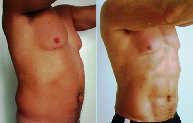 Vaser liposuction for removal of unwanted fat bulges in men at Castleknock Cosmetic Clinic Dublin