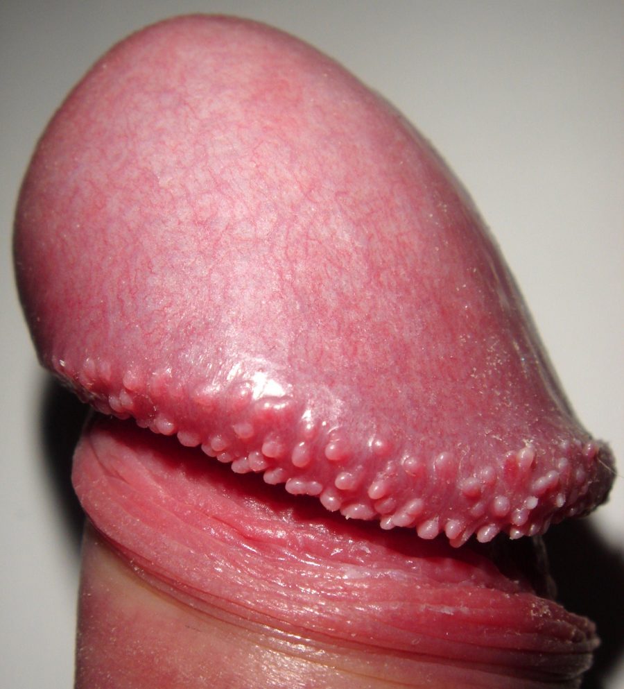 pearly penile papules treatment at Castleknock cosmetic clinic dublin