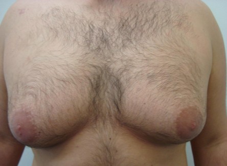 Man Boobs: Not any more - Castleknock Cosmetic Clinic