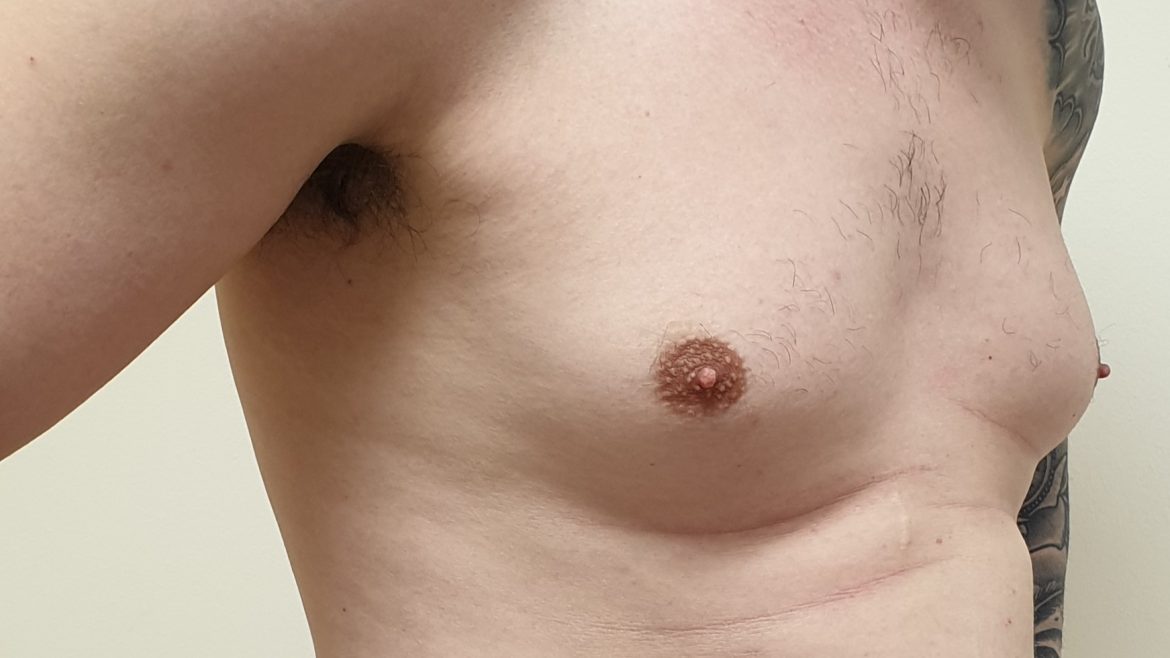 VASER vs gland excision for gynaecomastia: which do you need?