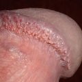 Pearly Penile Papules PPP