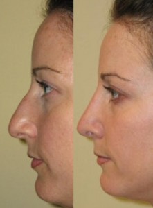 Nose reshaping dermal fillers non-surgical nose correction rhinoplasty