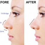 Non surgical nose reshaping rhinoplasty using dermal fillers a doctor blog Castleknock Cosmetic Clinic Dublin