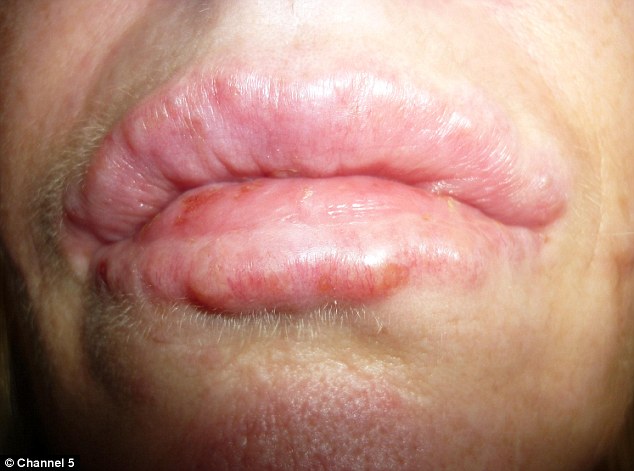 lumps and bumps in lips after dermal fillers