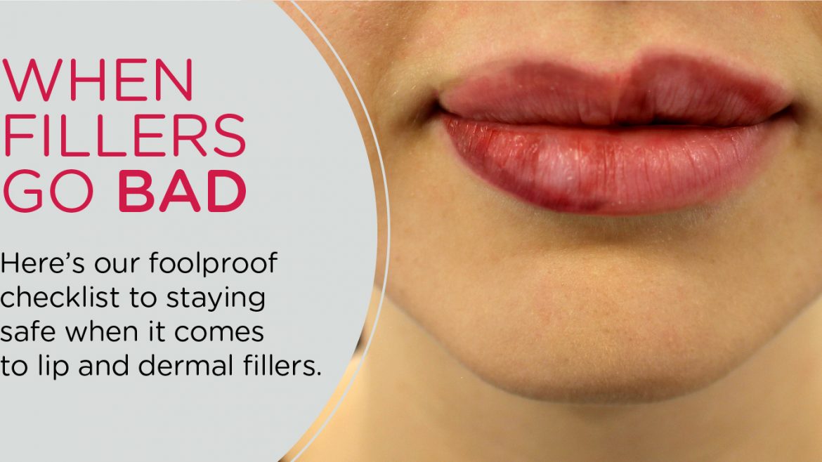 Have you ever had lumps after dermal fillers?