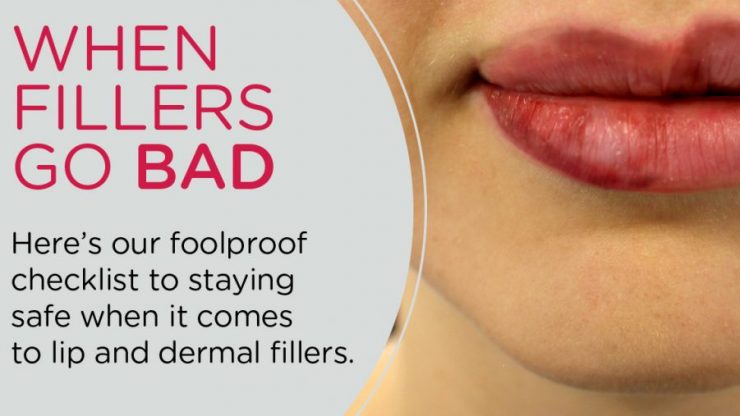 Have you ever had lumps after dermal fillers?