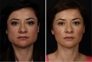 v shaped jawline sculpting and contouring using muscle relaxing injection for wrinkles