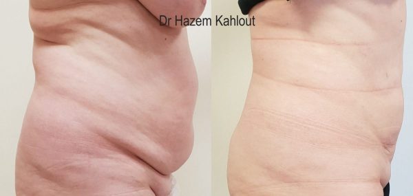 abdominal vaser liposuction
