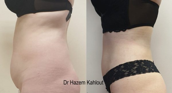 Anterior abdomen vaser liposuction tummy