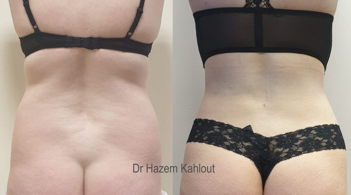 Curvy hourglass cinched waist silhouette with VASER liposuction