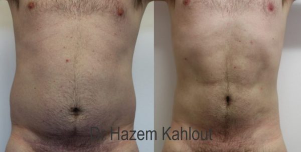 Hidef Vaser Lipo Drk Castleknock Cosmetic Clinic