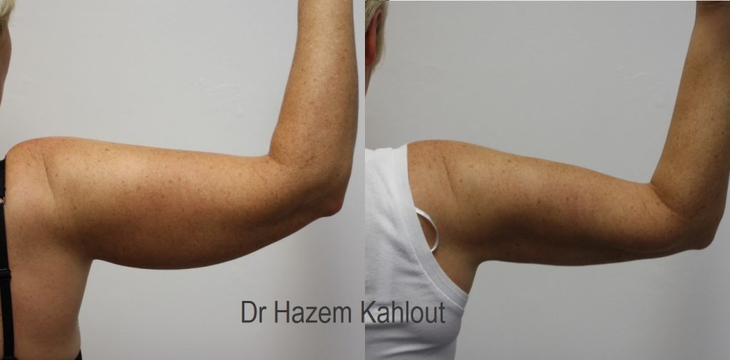 Arm Liposuction With Vaser Castleknock Cosmetic Clinic