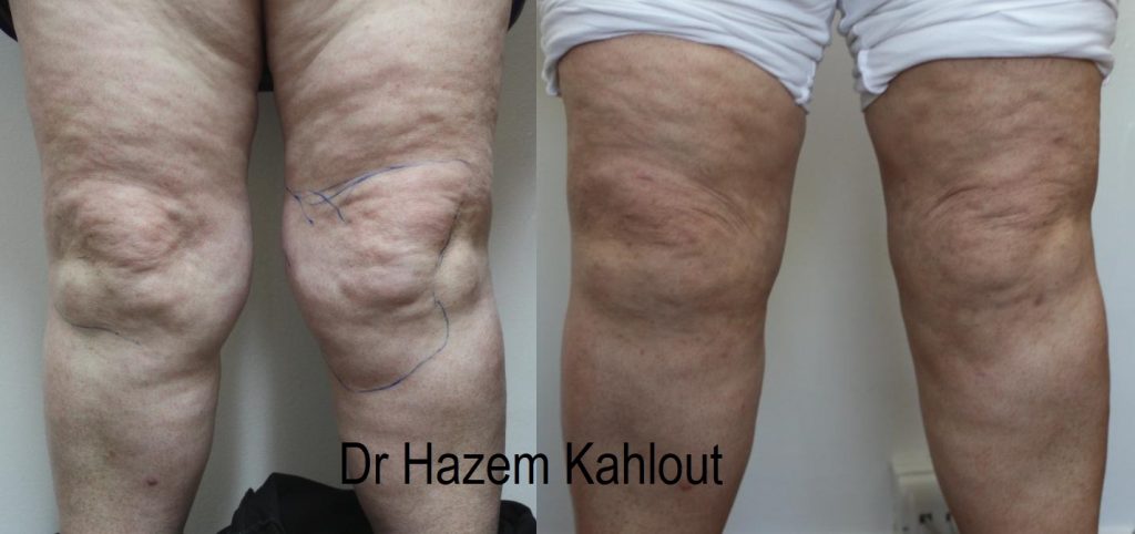 Knee Fat Pad VASER liposuction