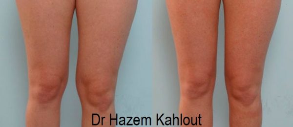 Knee Liposuction With Vaser And Renuvion J Plasma Skin Tightening 