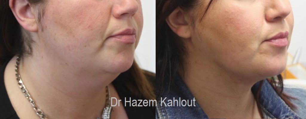 Neck and chin liposuction VASER