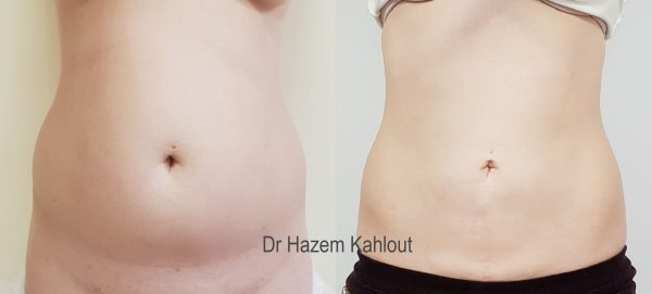 abdominal vaser liposuction