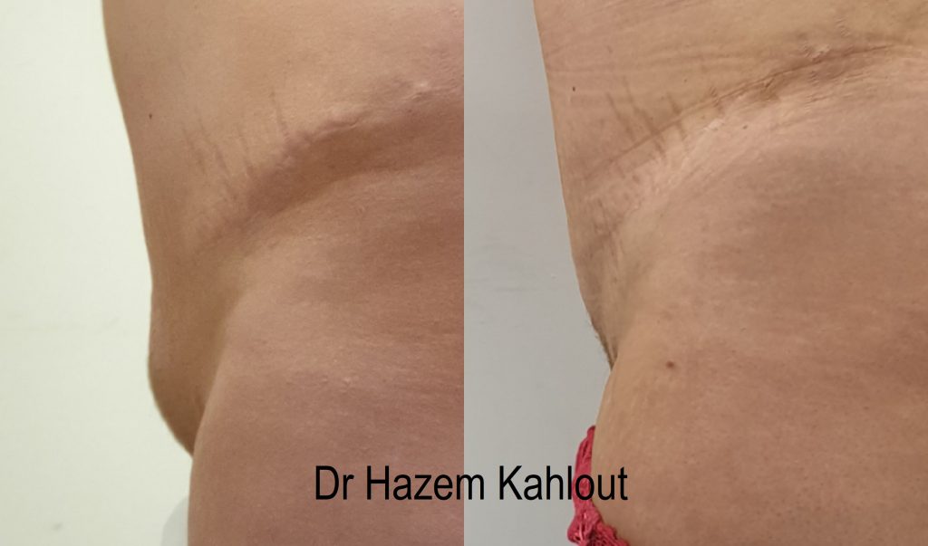 Lipo 360, Mons Pubis w/ Excision, Before and After