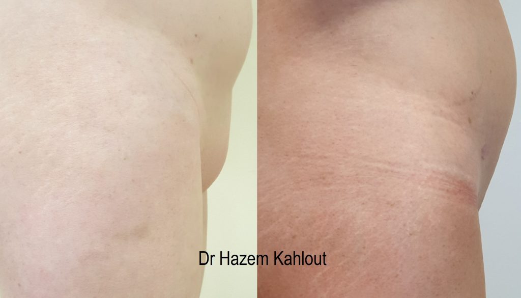 Mons Pubis groin region fat pad treatment liposuction with VASER