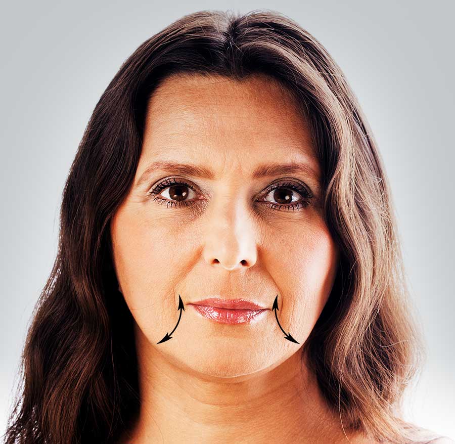 marionette lines dermal filler treatment
