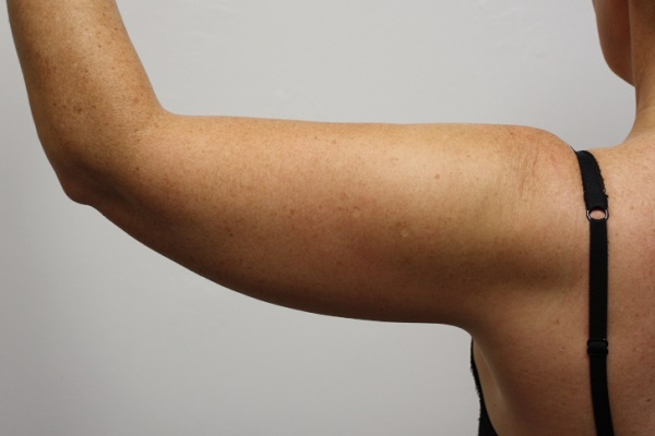 Arms Bingo Wings Liposuction VASER before