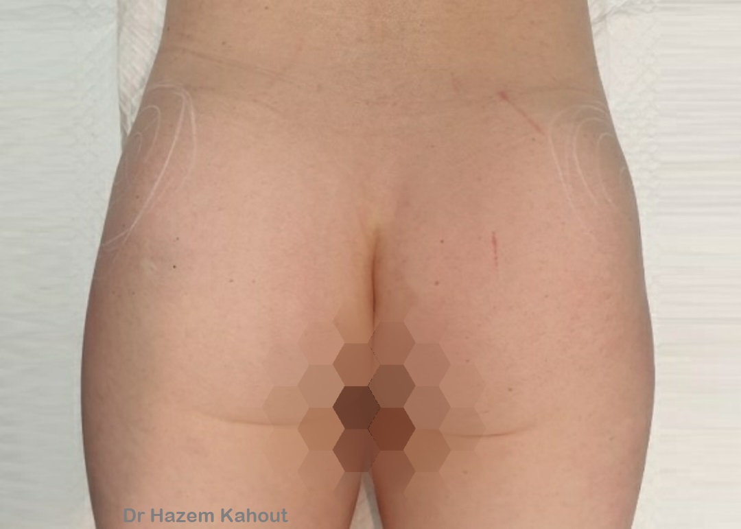 Sculptra Butt Lift After