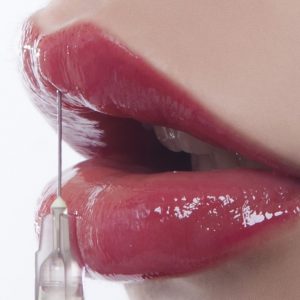 Lip augmentation dermal filler injection  
