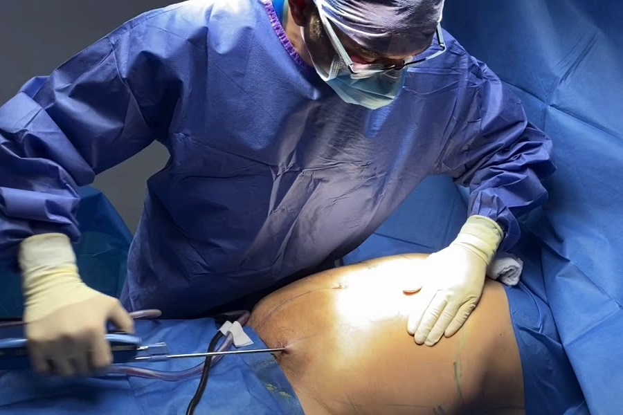 Price guide list for VASER liposuction