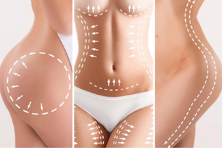 Price guide list for VASER liposuction