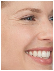 Crows feet before botox injection