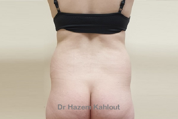 How To Get a Snatched Waist: Liposuction vs Tummy Tuck