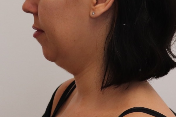 neck and jawline VASER liposuction before