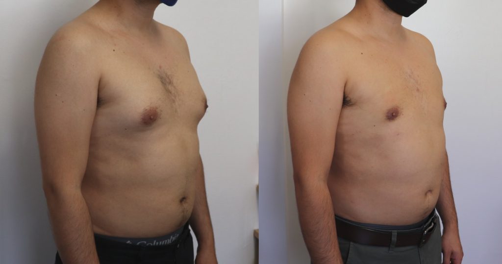Male chest gynaecomastia reduction copyright image dr hazem kahlout Castleknock cosmetic clinic