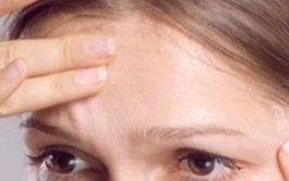Worry lines botox treatment
