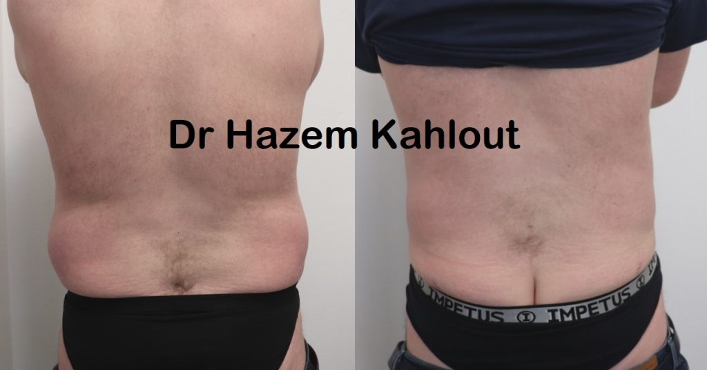 male flanks before and after by bd hazem kahlout Castleknock cosmetic clinic